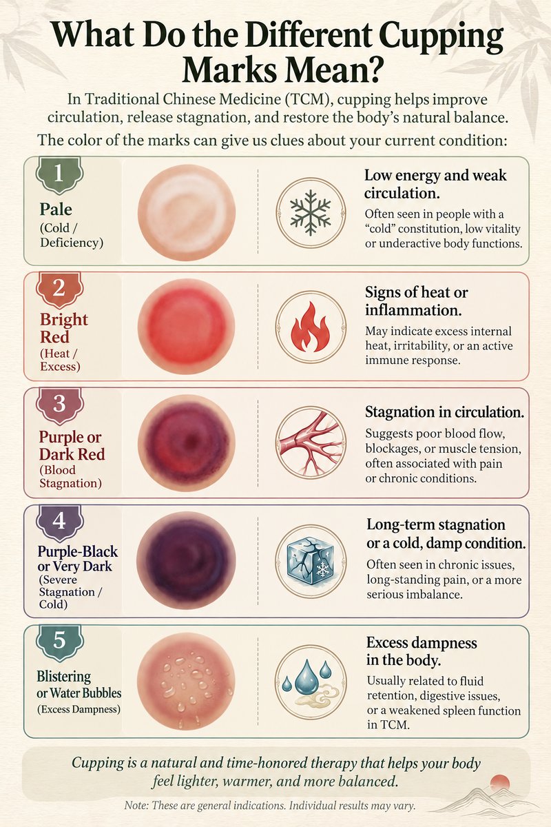 Chart explaining what different cupping mark colors mean in TCM